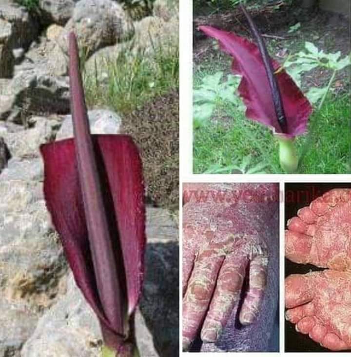 SEDEF HASTALIĞI İÇİN MUCİZE